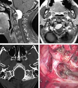 Far Lateral Suboccipital (Transcondylar) Approach | Cohen Collection | Volumes | The Neurosurgical Atlas
