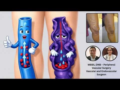Varicose Veins Problem & Treatment | Telugu Health Video