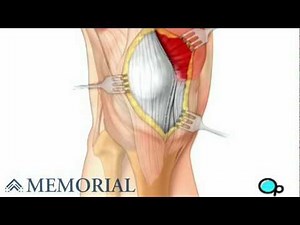Knee Replacement Surgery