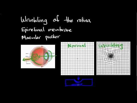 Wrinkling of the retina