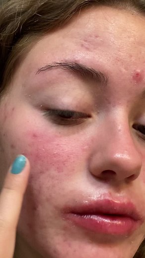 The Ordinary Red Face Mask: How to Use It Safely on Accutane