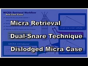 Micra Leadless Pacemaker Retrieval: Real Case Using Dual-Snare Technique