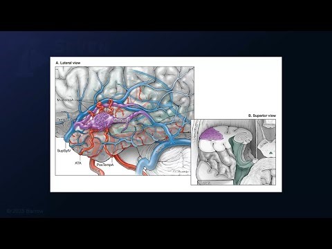 Microsurgical Resection of a Lateral Temporal AVM: Skeletonization Technique for En Passage Arteries