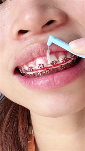 braces hygiene with me with this 8 pcs ortho kit💯🥰 #orthokit #kit #dentalkit #oralhygiene #oralcare