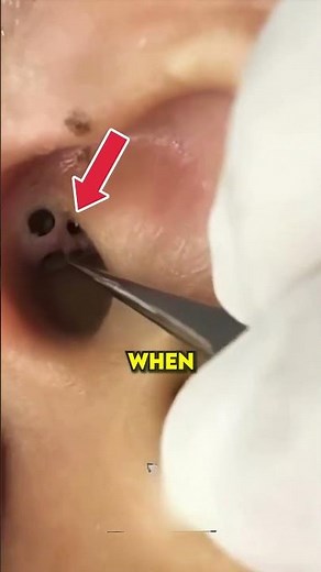 Doctor Clears the Largest Ear Pore Ever! (Satisfying!)