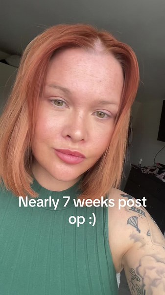 Nearly 7 weeks post deepplane face and necklift upper eyelid surgery brow lift and forehead lift in turkey