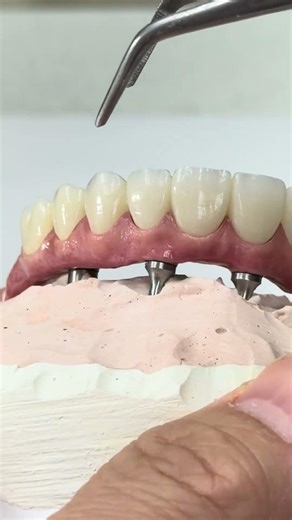 The best full mouth implants prosthetics!
