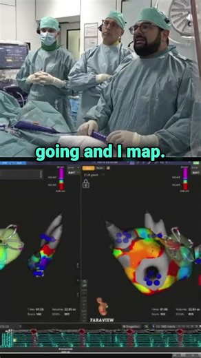 Precision Mapping for PFA Pulmonary Vein Isolation