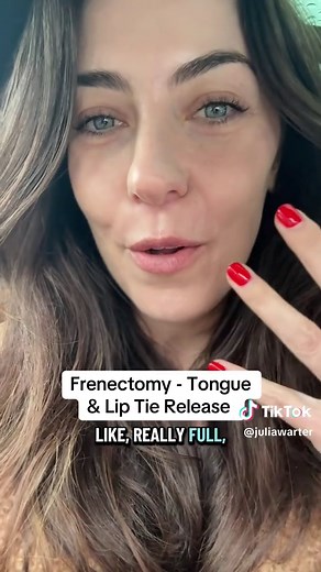 Successful Frenectomy for Tongue and Lip Ties
