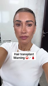 Hair Transplant Journey: My Cairo Experience