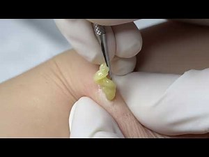 Cyst deep extraction & deep blackhead extraction | Satisfying Pimple Popping ASMR (No Talking)