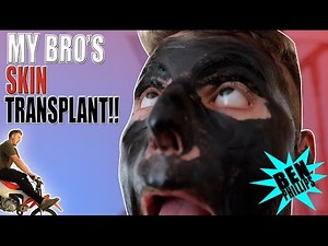 Skin Transplant Fail! PRANK!