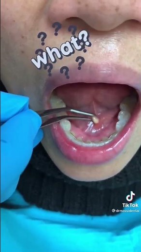What’s that ?!Salivary Gland stones