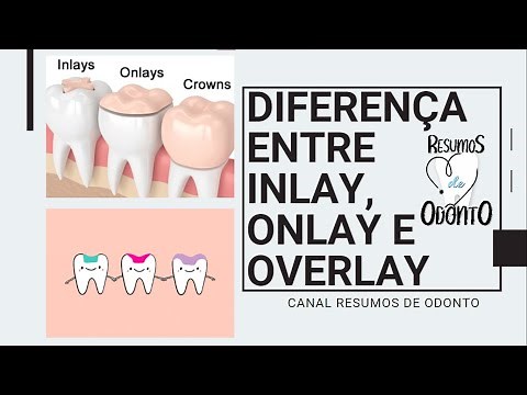 Explicando sobre inlay, onlay e overlay | Resumos de Odonto
