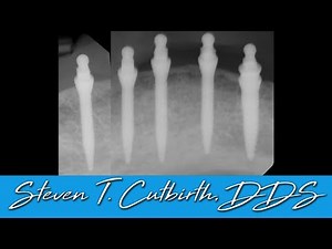 Mini Implants to Secure Mandibular Denture - Dental Minute with Steven T. Cutbirth, DDS