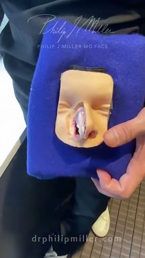 What Is Spreader graft In Rhinoplasty? Let Dr. Miller Explain