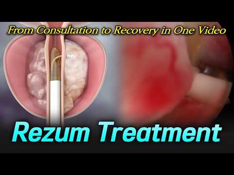 Rezum Treatment Explained: From Consultation to Recovery
