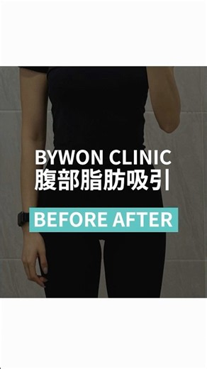 お腹の脂肪吸引BEFORE＆AFTER！360度隅々までチェック✨ #shorts