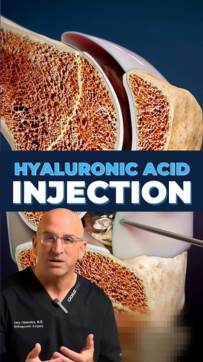 The TRUTH About Knee Injections for Arthritis Pain⁉️ Hyaluronic acid injections have emerged as a promising non-surgical treatment option for knee osteoarthritis, offering hope for millions of patients seeking relief from joint pain and stiffness. But how exactly do these injections work, and what makes them effective? Hyaluronic acid is naturally found in healthy synovial fluid, the lubricating substance that cushions our joints. Think of it as your knee's natural shock absorber and lubricant. 