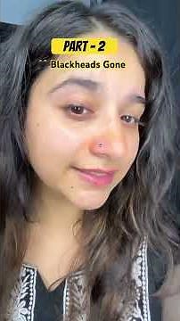 Part 2 🖤 Blackheads Gone! See the Result #viral #skincare #amazing #result