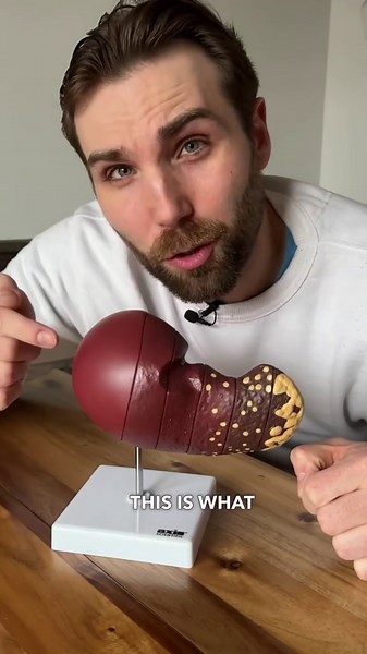 Liver Damage in 3 Stages—And How to Catch It Early