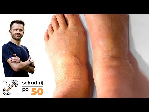 Water, Lymph, and Edema: A Diet for Swollen Legs