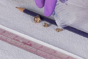 Why do stents cause some kidney stone patients pain? - UW Medicine | Newsroom