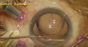 Transconjunctival Intrascleral IOL Fixation With Double Needle Technique - Eyetube