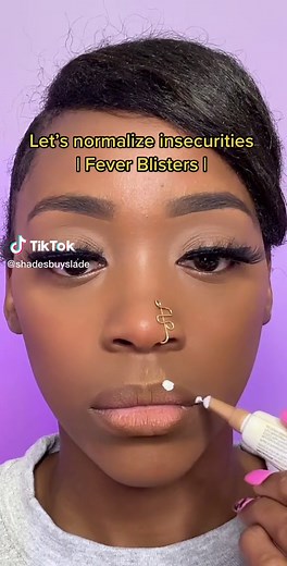 Embracing Our Imperfections: Understanding Fever Blisters