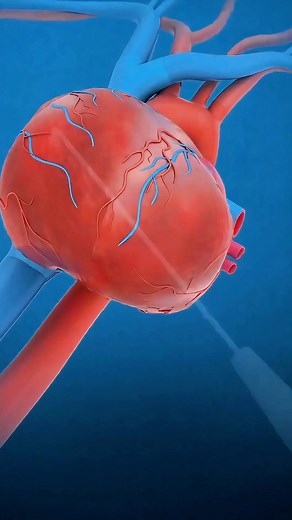 "Laser Heart Surgery: Transmyocardial Revascularization Explained!" Transmyocardial Revascularization (TMR) is a heart surgery used when traditional bypass isn’t possible. In this procedure, surgeons use a laser to create tiny channels directly in the heart muscle (myocardium). These channels improve blood flow and help the heart get more oxygen, reducing chest pain (angina). #HeartSurgery #TransmyocardialRevascularization #TMRsurgery #CardiologyFacts #MedicalEducation #LaserSurgery #HeartHealth