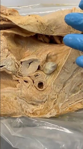 Ectopic Pregnancies 101