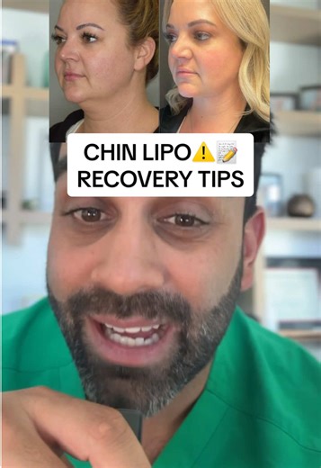 If you’re considering getting chin lipo… watch this video! You just found the best chin lipo surgeon out there 👋🏽 here to share some recovery tips and before and after results, 2026 is the year for a snatched jawline 🎉 #chinlipo #chinliposuction #doublechin #doublechinreduction #jawline