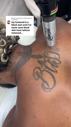 Laser Tattoo Removal Specialists in Adelaide | Trusted Clinic