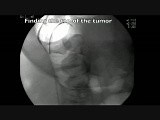 Colonoscopy Channel - Management Of Colon Obstruction - Stent Insertion • Video • MEDtube.net
