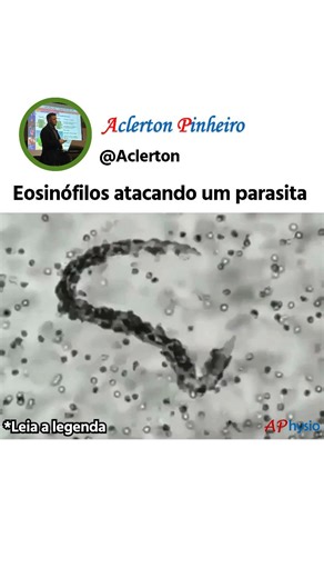 APhysio / Fisiologia, Farmacologia e Bioquímica on Instagram: "O eosinófilo é uma célula de defesa bem característica: tem núcleo em dois lobos e o citoplasma cheio de grânulos que guardam proteínas tóxicas, como a MBP (major basic protein), a ECP/EDN (ribonucleases) e a EPO (peroxidase). Ele não está ali só para inflamações alérgicas: tem papel em remodelamento tecidual, mas o grande destaque é o combate a parasitas multicelulares, como vermes. . O processo começa quando o tecido infectado libe