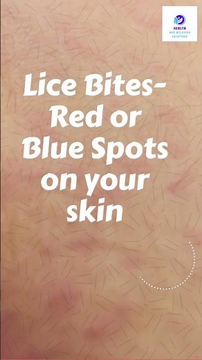 Signs and Symptoms of PUBIC LICE or “CRABS”