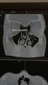What ENT doctors look for on a Sinus CT Scan