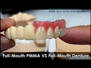 Full-Mouth Implant: PMMA VS Denture Concept | Side-By-Side Comparison