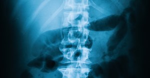 Abdominal X-rays - Mind The Bleep