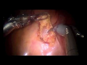 Single Site Plus 2 Robotic Colposuspension • Video • MEDtube.net