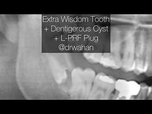 Dentigerous Cyst and Supernumerary Third Molar Removal. L-PRF Fibrin Plug Placememt