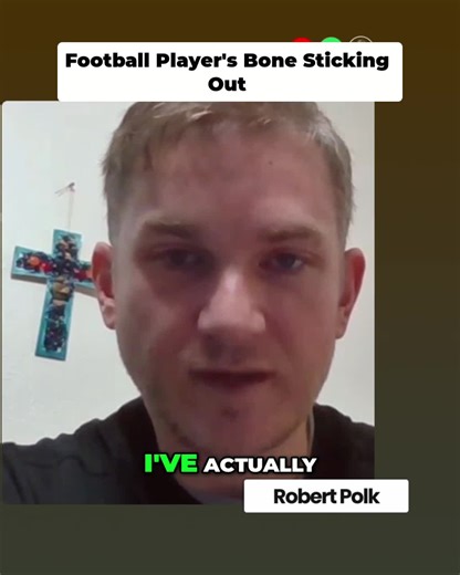 Brutal open tibia fracture during the game. A career-altering moment no athlete wants to face. #FootballInjury #OpenFracture #SportsTrauma #MedicalCase