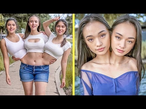 15 Conjoined Twins Who Touched the World with Their Unbreakable Bond