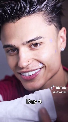 Dealing with Bad Pimples: Tips and Tricks