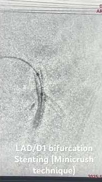 LAD/D1 bifurcation Stenting (Mini crush technique)