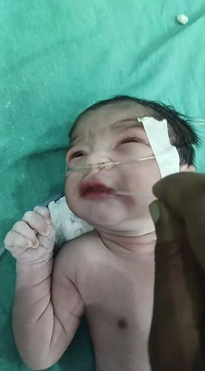 How Newborn Baby C-Section is Done | Part 2 Explained.🥳 #CSection #BabyDelivery #CaesareanSection