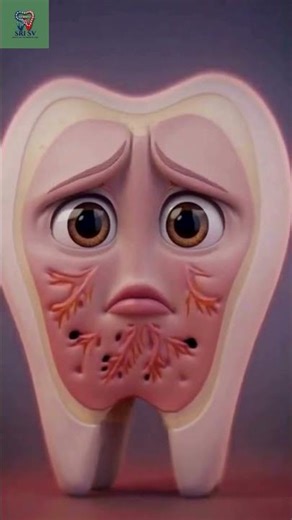 Root Canal Treatment Explained | Tooth Pain Solution | Sri SV Dental