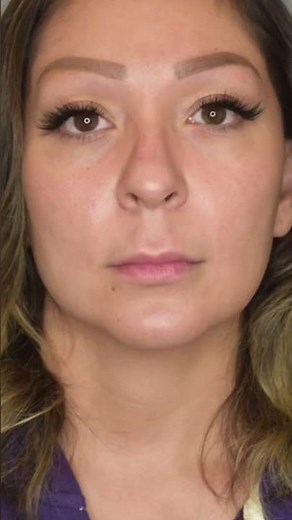 Lip Lift Surgery + RESULTS #beforeandafter #plasticsurgery #lips