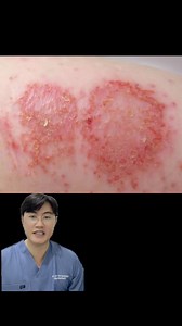 35K views · 696 reactions | ជំងឺតាអក Nummular dermatitis Endogenous eczema By Dr. Sopheaktra Thea, MD. MSc #eczema #skincareroutine #Dermatologist #ជំងឺតាអក | ពេទ្យសើស្បែក វេជ្ជ. ពិទូរ្យ -Dr. P2 Dermatology Clinic | Facebook