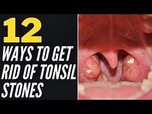 12 Ways To Get Rid Of Tonsil Stones At Home